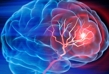 What People Should know about stroke